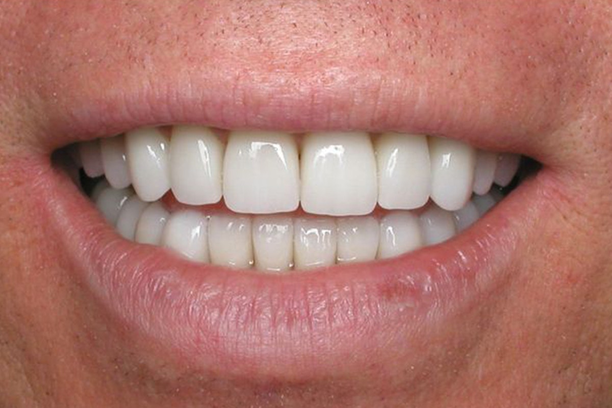 Dr. Andrew Mortensen's patient after FMR in Huntington Beach, CA