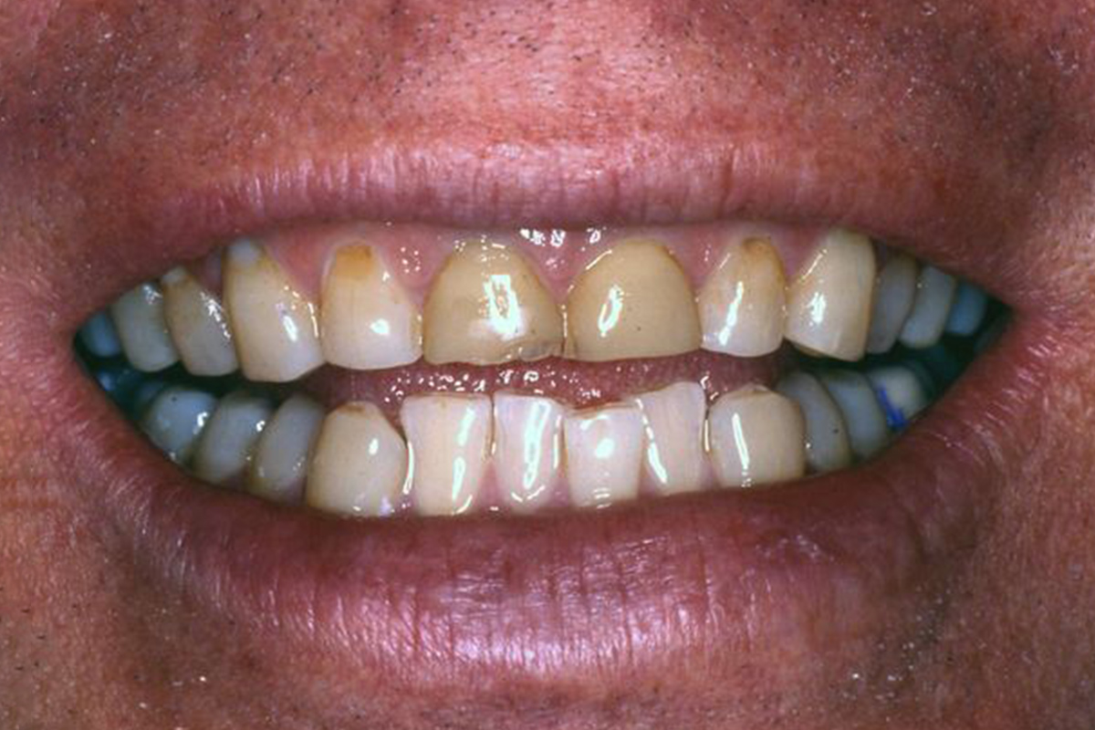Dr. Andrew Mortensen's patient before full mouth reconstruction