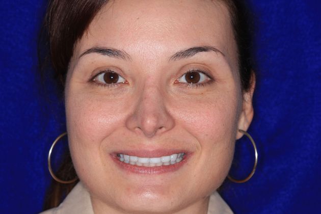 Dr. Andrew G. Mortensen's patient after porcelain veneers