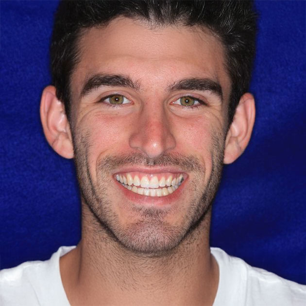 Man after dental bonding