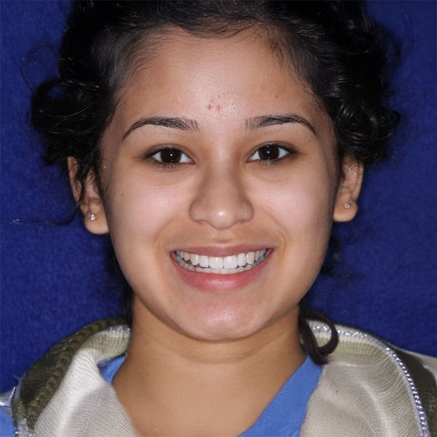 Woman after teeth whitening