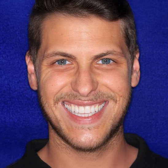 Man with dental crowns