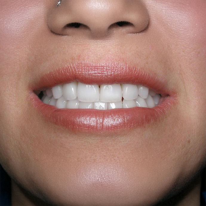 Invisalign aligners on teeth