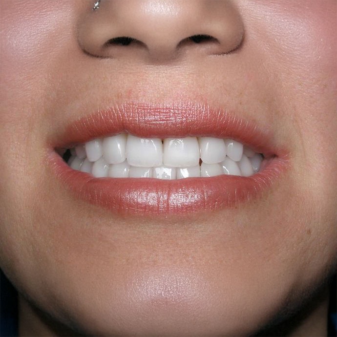 Invisalign aligners on teeth