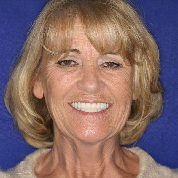 Woman with dental implants