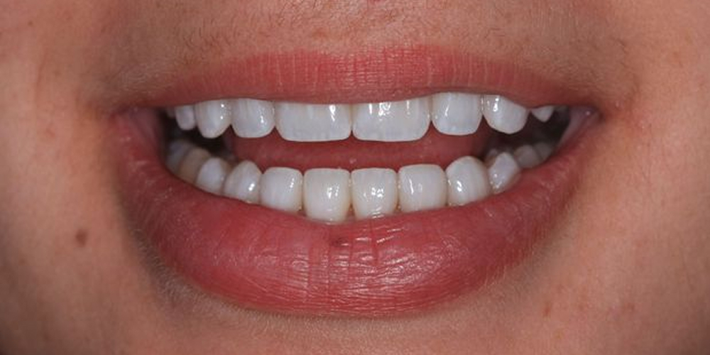 After veneers