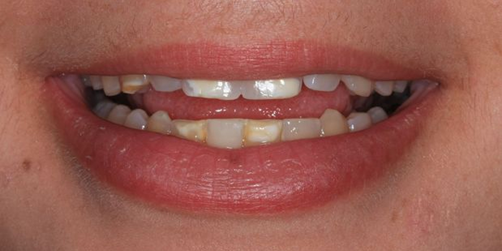 before veneers