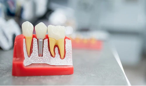 3D of Dental Implants