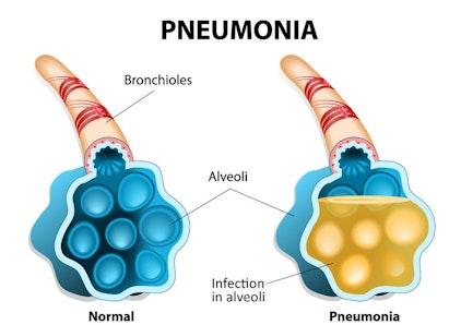 Illustration highlighting the results of pneumonia