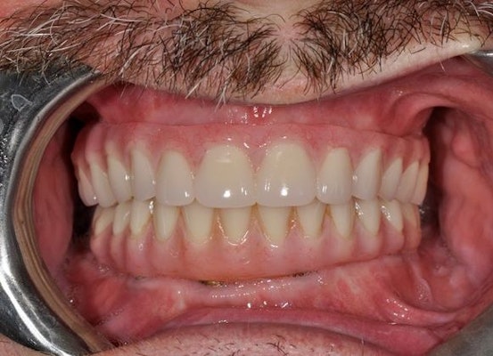 After dentures procedure