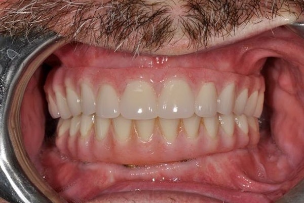 After dentures procedure