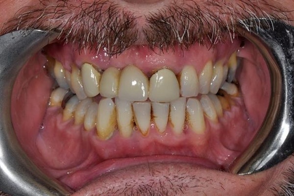 Before dentures procedure