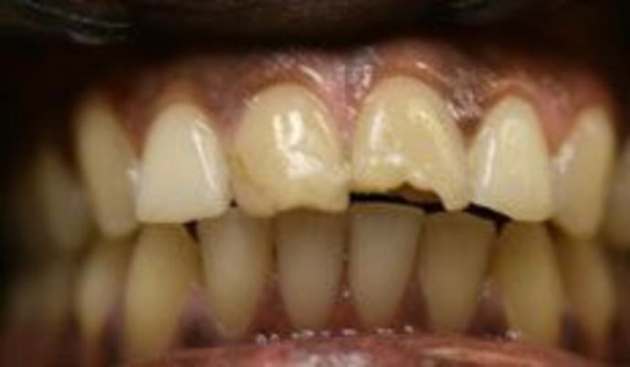 Cracked tooth before veneers