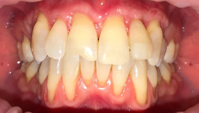 smile before invisalign