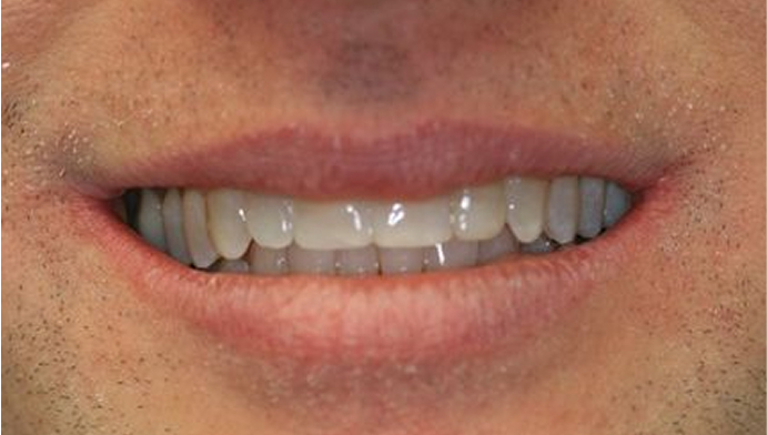 smile after invisalign