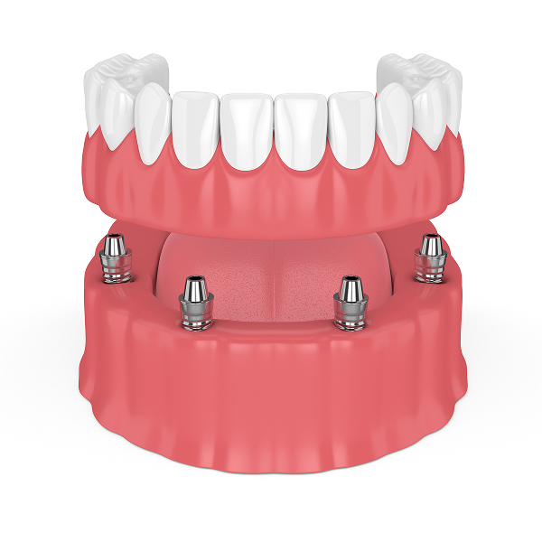 all-on-4 implants