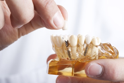 dental implants