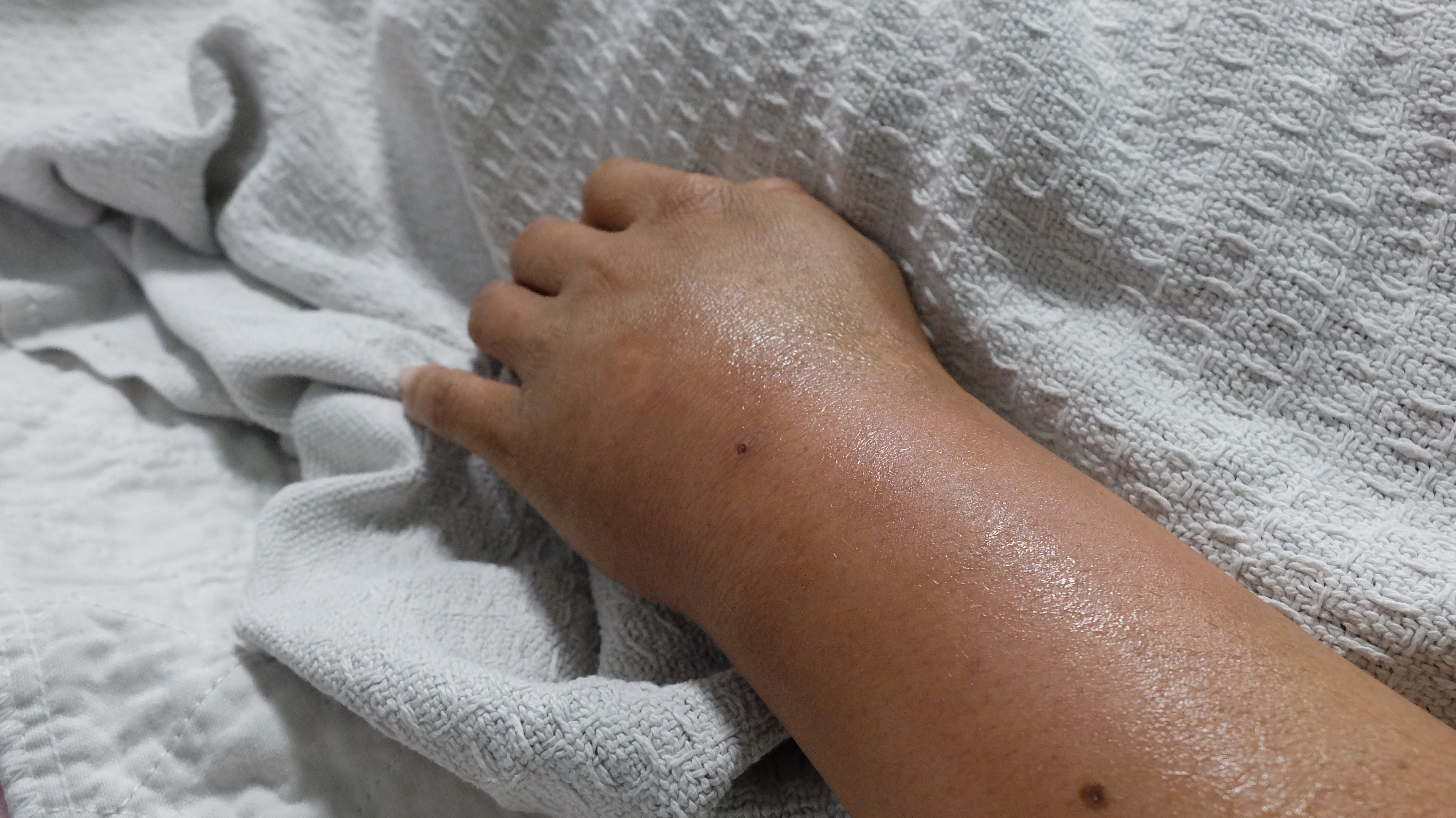 Swollen arm and hand