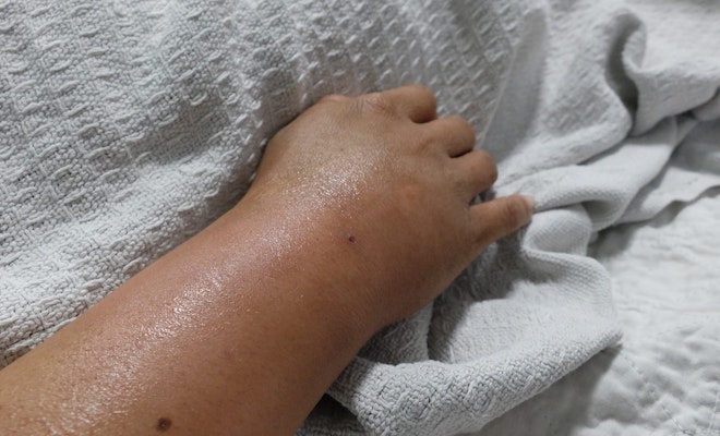 Swollen arm and hand