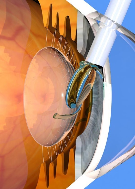 Intraocular Lens