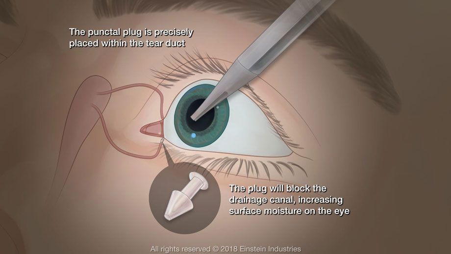 illustration stating: The punctal plug is precisely placed within the tear duct. The plug will block the drainage canal, increasing surface moisture of the eye.