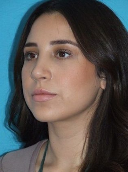 Woman after rhinoplasty