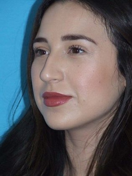 Woman before rhinoplasty