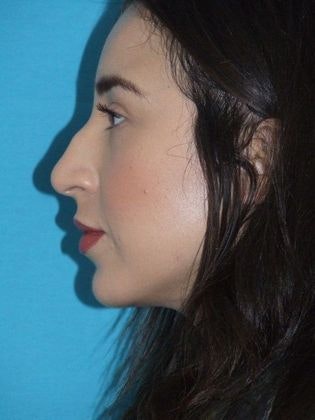 Patient before rhinoplasty