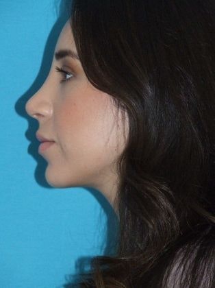 Patient before rhinoplasty