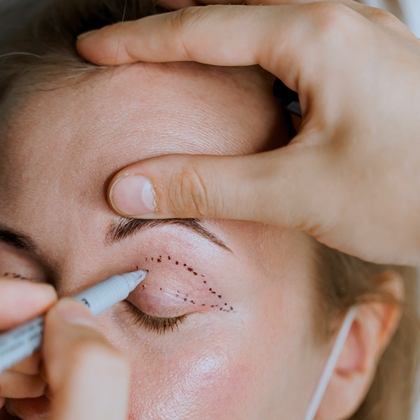 woman getting prepped for blepharoplasty