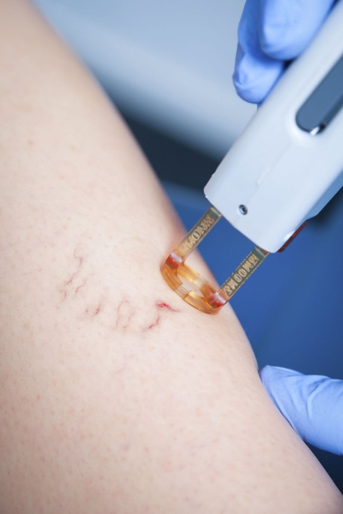 Close up of legs with spider veins