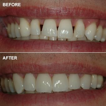 Before and after cosmetic dentistry — Dr. James Slaman, Albuquerque