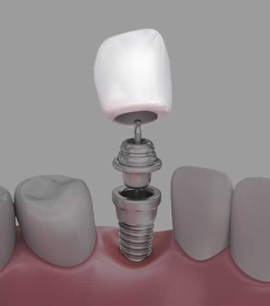 Dental Implant