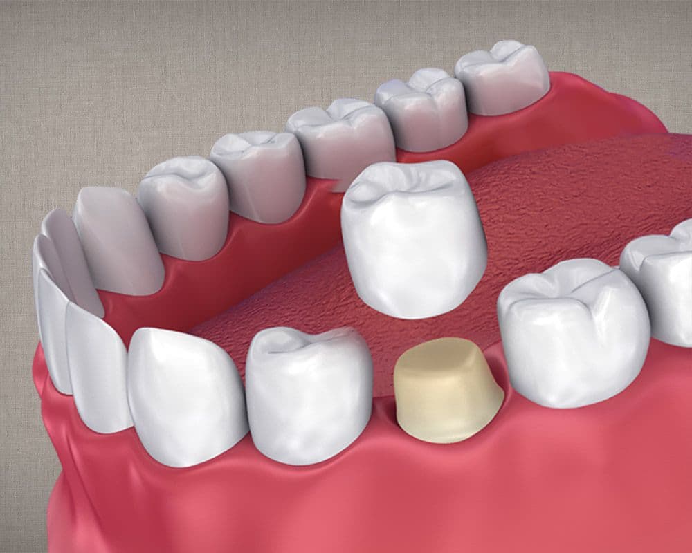 Dental Crown 3D Model