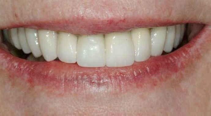 After reconstruction