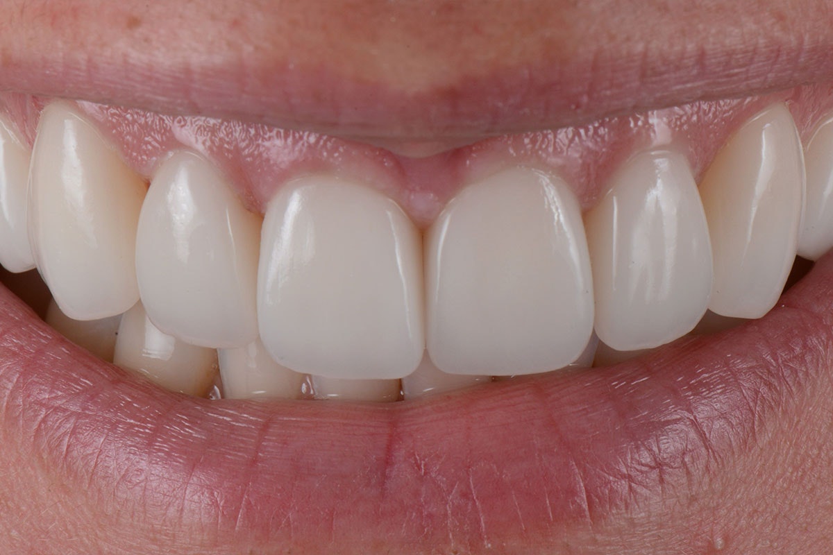Dental Care - After