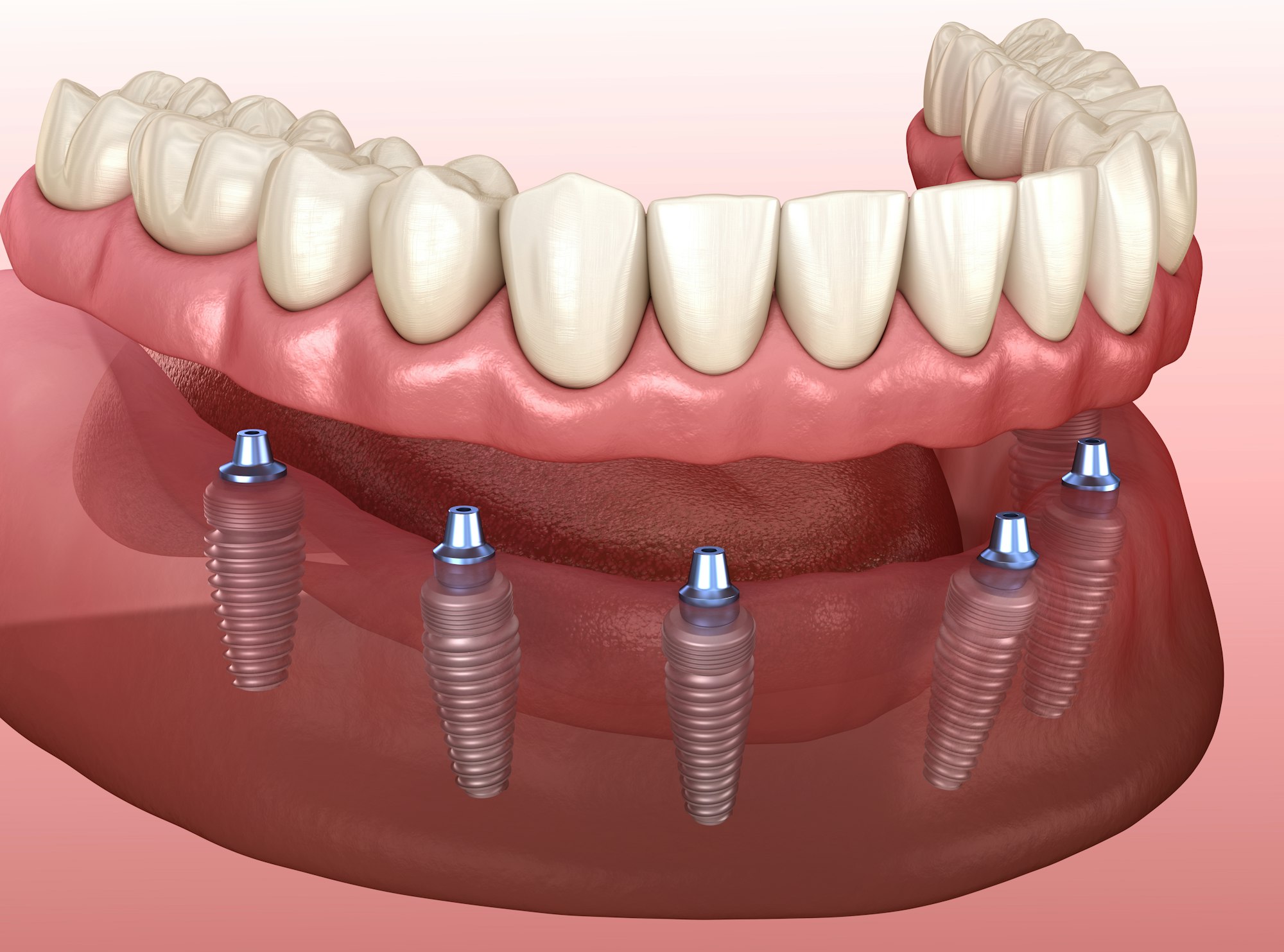 implant-supported dentures