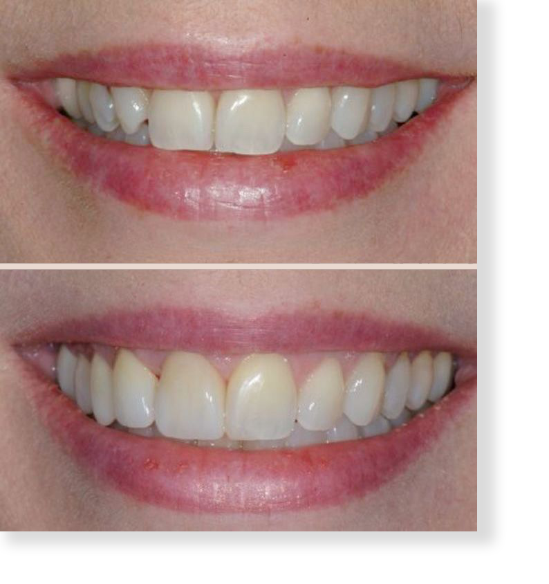 Before and After Dental Veneers