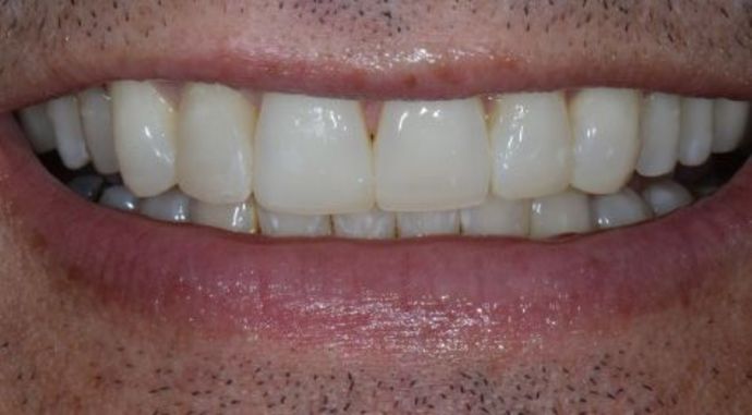 Dr. James Slaman's patient after smile makeover