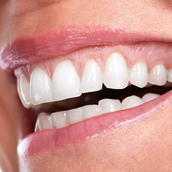 Gum contouring at Dr. James Slaman