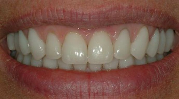 A perfect white smile after smile makeover