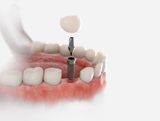 Illustration of an implant-supported crown