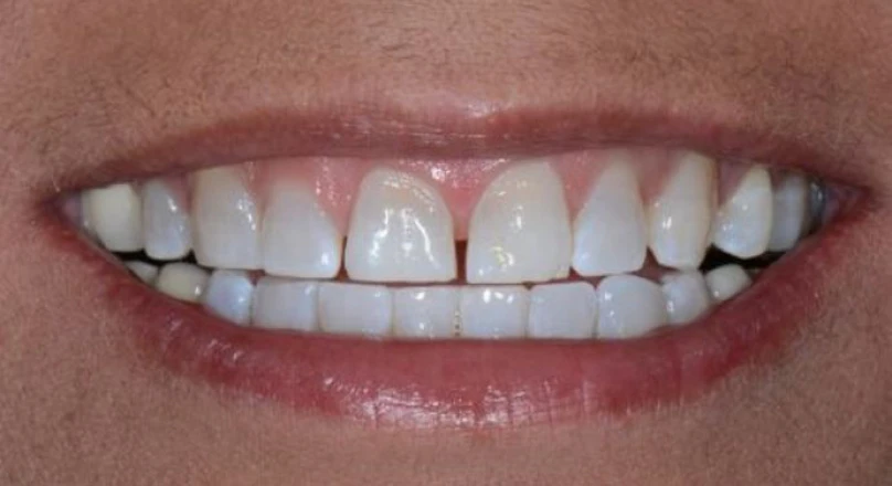 smile before veneers