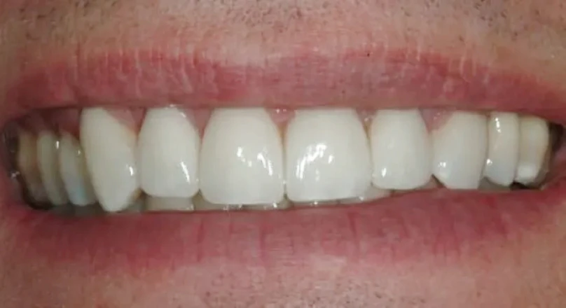 after veneers