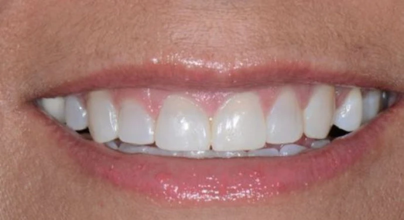 smile after veneers