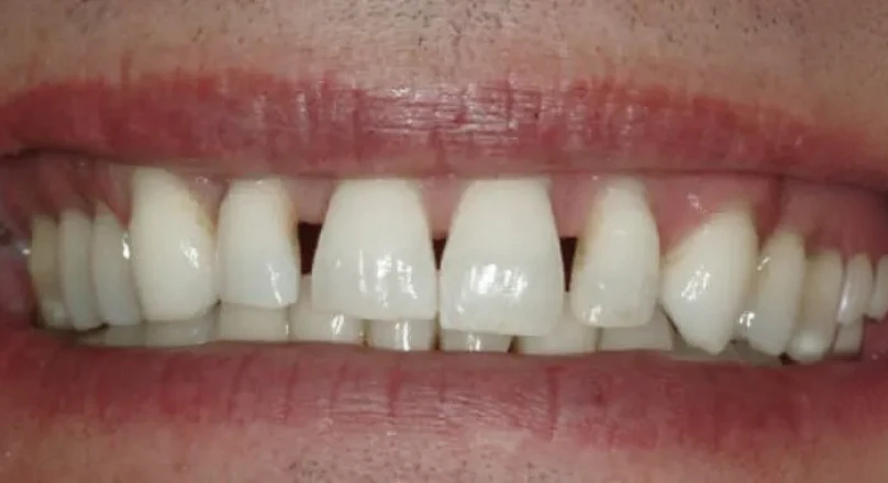 before veneers