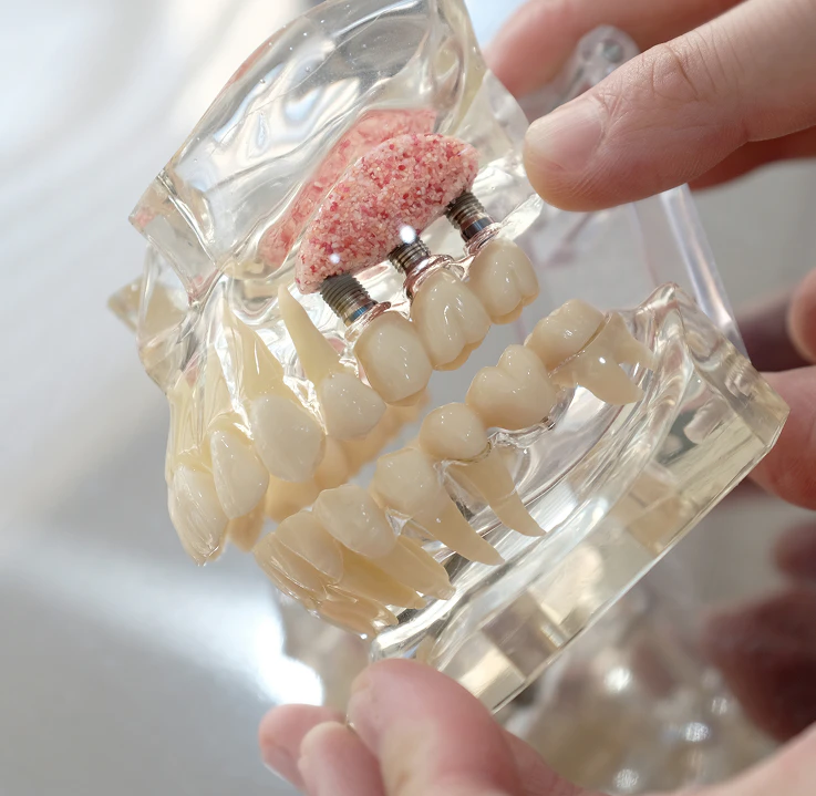 Close-up of a dental implant model