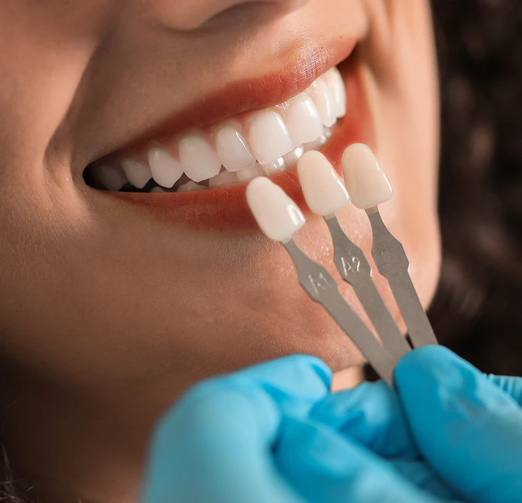 close-up of a woman being shade matched for veneers