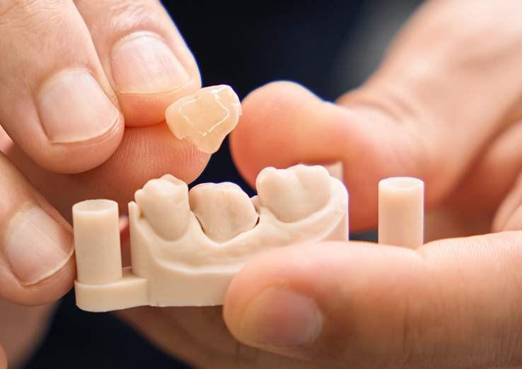 Dental crowns at Dr. James Slaman