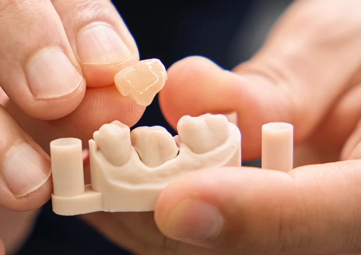 close-up of a dental crown being placed on a plastic model